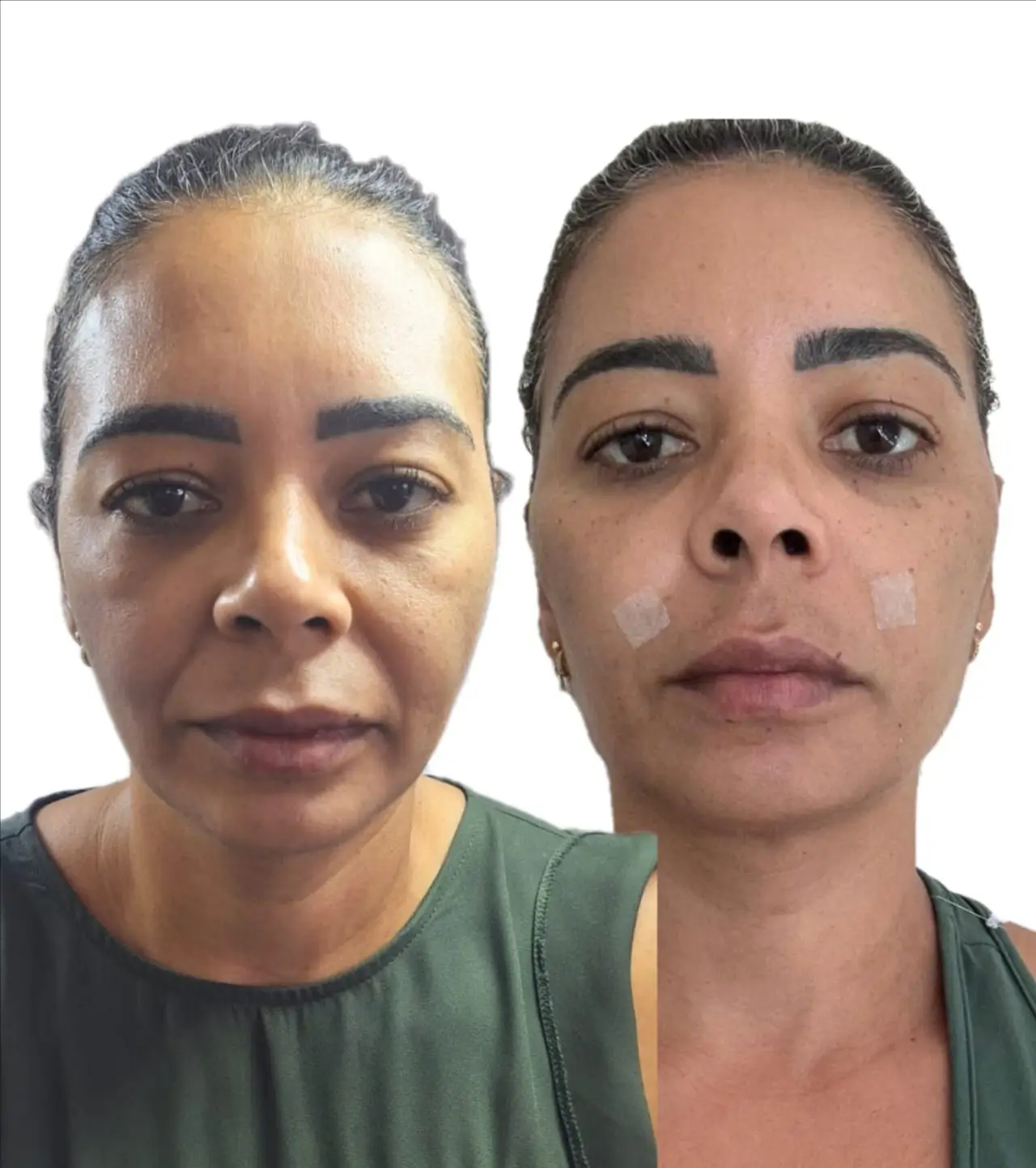 Aplicação de Fios de Sustentação e Botox