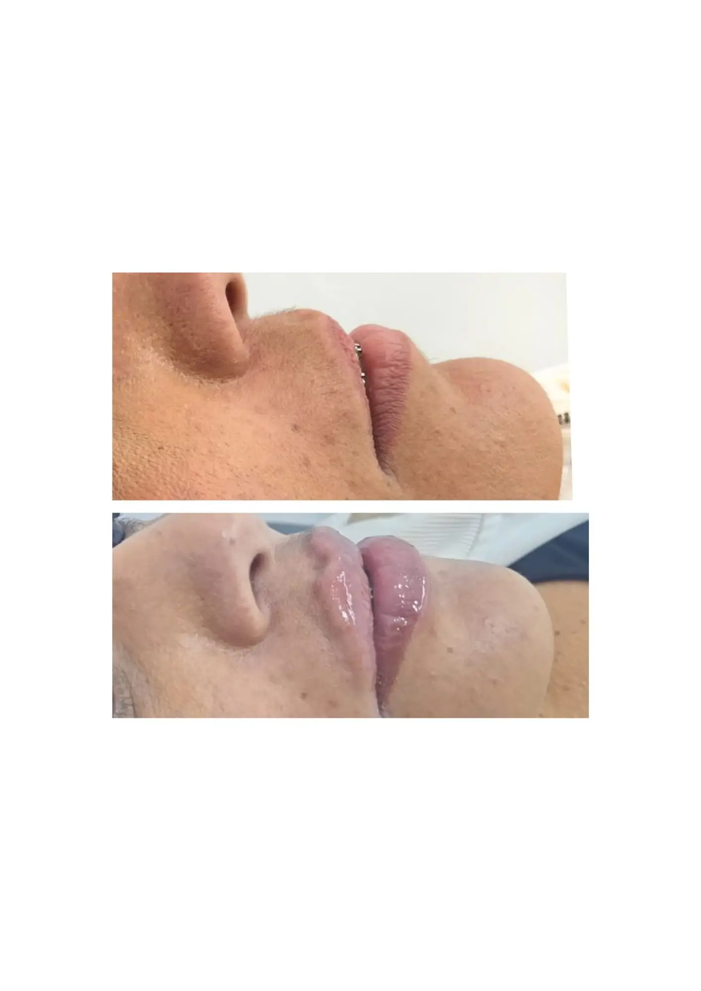 Antes e depois de Preenchimento Labial